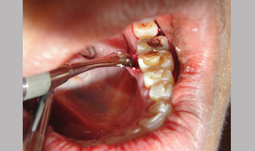 Cosmetic dentistry treatment in Anand
                        